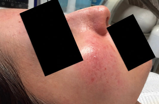 Sensitive Skin Facial Beverly Hills | Skincare 90210