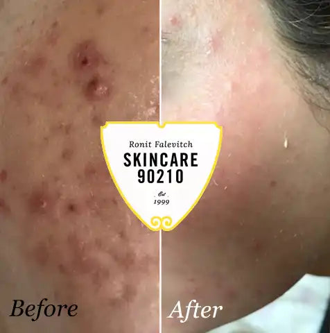 Acne Facial In Beverly Hills | Skincare 90210